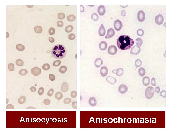 Anisocytosis Anisochromasia 