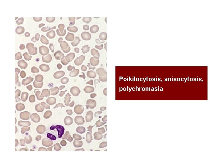 Poikilocytosis, anisocytosis, polychromasia 