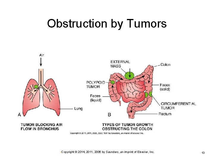 Obstruction by Tumors • Copyright © 2014, 2011, 2006 by Saunders, an imprint of Obstruction by Tumors • Copyright © 2014, 2011, 2006 by Saunders, an imprint of