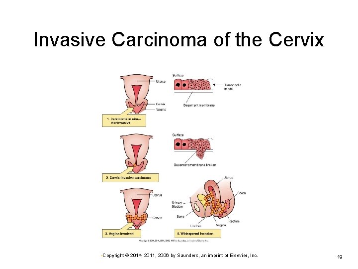 Invasive Carcinoma of the Cervix • Copyright © 2014, 2011, 2006 by Saunders, an Invasive Carcinoma of the Cervix • Copyright © 2014, 2011, 2006 by Saunders, an