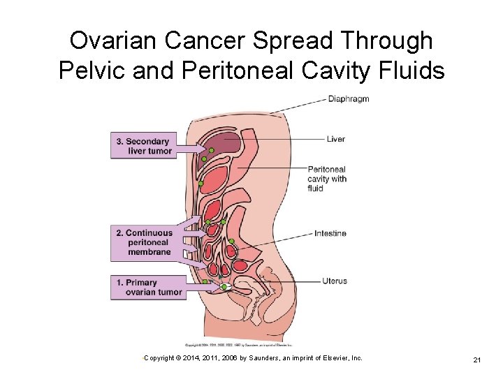 Ovarian Cancer Spread Through Pelvic and Peritoneal Cavity Fluids • Copyright © 2014, 2011, Ovarian Cancer Spread Through Pelvic and Peritoneal Cavity Fluids • Copyright © 2014, 2011,
