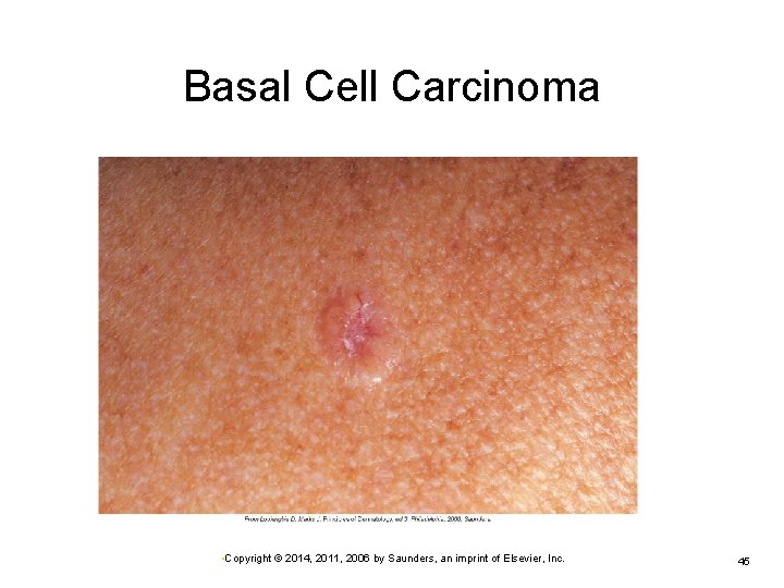Basal Cell Carcinoma • Copyright © 2014, 2011, 2006 by Saunders, an imprint of Basal Cell Carcinoma • Copyright © 2014, 2011, 2006 by Saunders, an imprint of