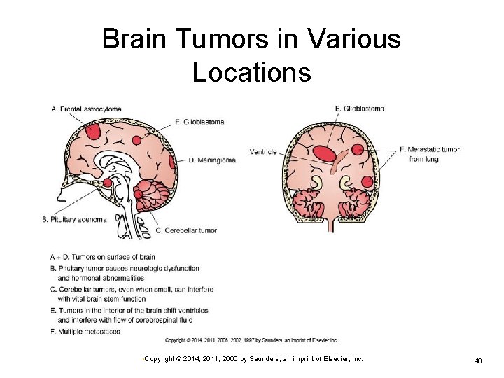 Brain Tumors in Various Locations • Copyright © 2014, 2011, 2006 by Saunders, an Brain Tumors in Various Locations • Copyright © 2014, 2011, 2006 by Saunders, an