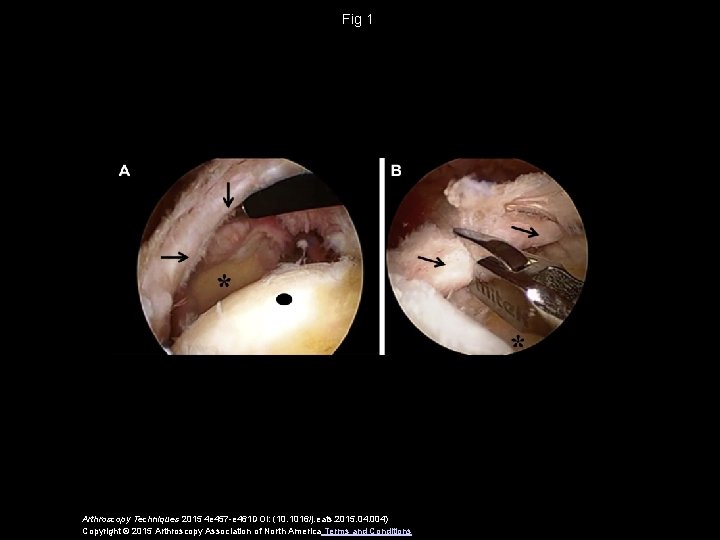 Fig 1 Arthroscopy Techniques 2015 4 e 457 -e 461 DOI: (10. 1016/j. eats.