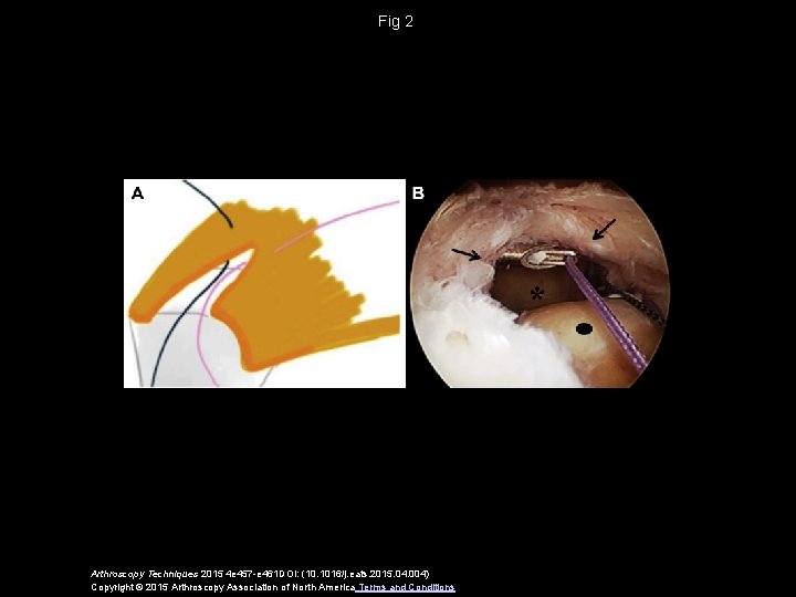 Fig 2 Arthroscopy Techniques 2015 4 e 457 -e 461 DOI: (10. 1016/j. eats.