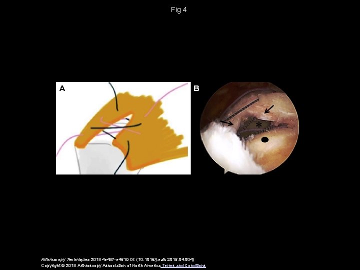 Fig 4 Arthroscopy Techniques 2015 4 e 457 -e 461 DOI: (10. 1016/j. eats.