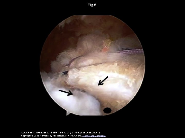 Fig 5 Arthroscopy Techniques 2015 4 e 457 -e 461 DOI: (10. 1016/j. eats.