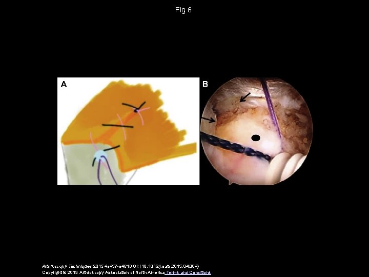 Fig 6 Arthroscopy Techniques 2015 4 e 457 -e 461 DOI: (10. 1016/j. eats.