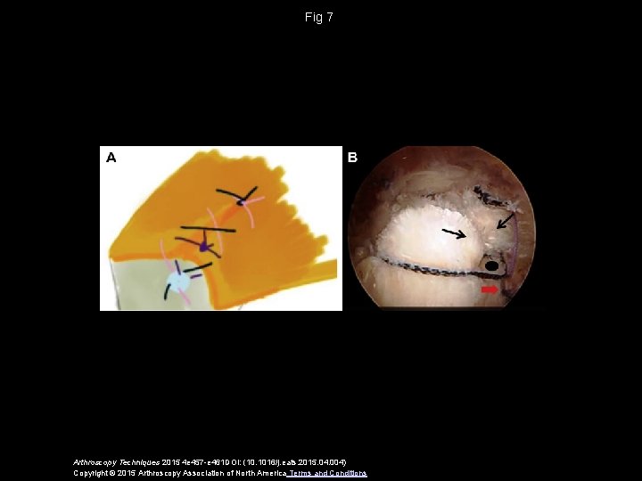 Fig 7 Arthroscopy Techniques 2015 4 e 457 -e 461 DOI: (10. 1016/j. eats.