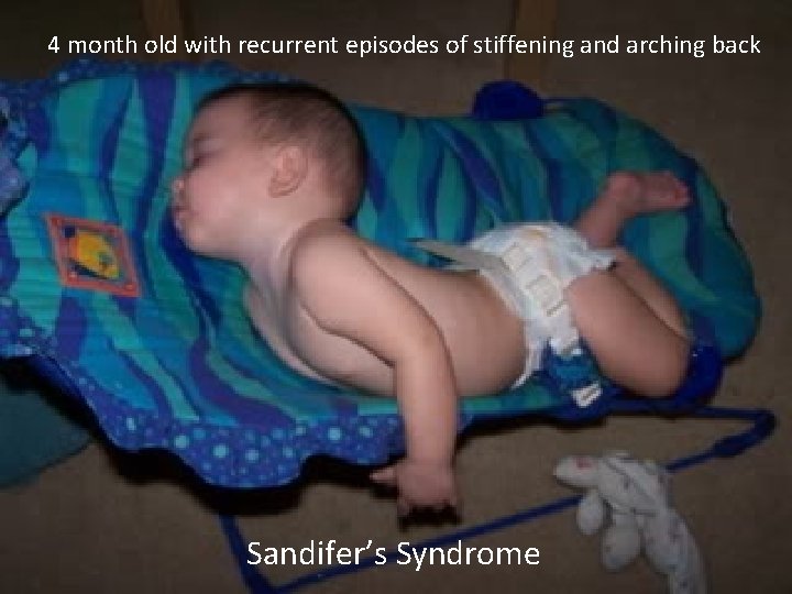 4 month old with recurrent episodes of stiffening and arching back Sandifer’s Syndrome 4 month old with recurrent episodes of stiffening and arching back Sandifer’s Syndrome