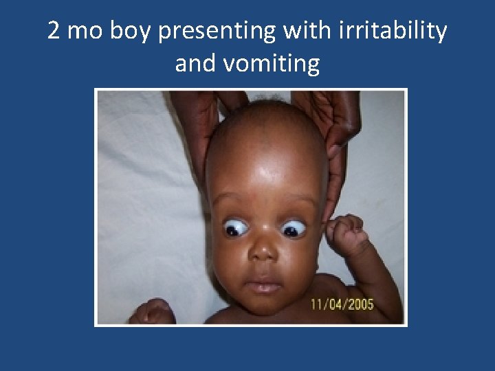 2 mo boy presenting with irritability and vomiting 2 mo boy presenting with irritability and vomiting