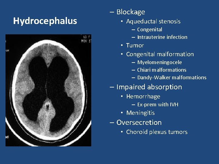 Hydrocephalus – Blockage • Aqueductal stenosis – Congenital – Intrauterine infection • Tumor • Hydrocephalus – Blockage • Aqueductal stenosis – Congenital – Intrauterine infection • Tumor •
