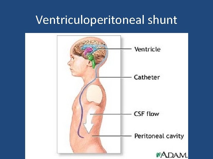 Ventriculoperitoneal shunt Ventriculoperitoneal shunt