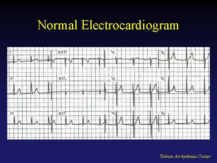 Normal Electrocardiogram Tehran Arrhythmia Center 