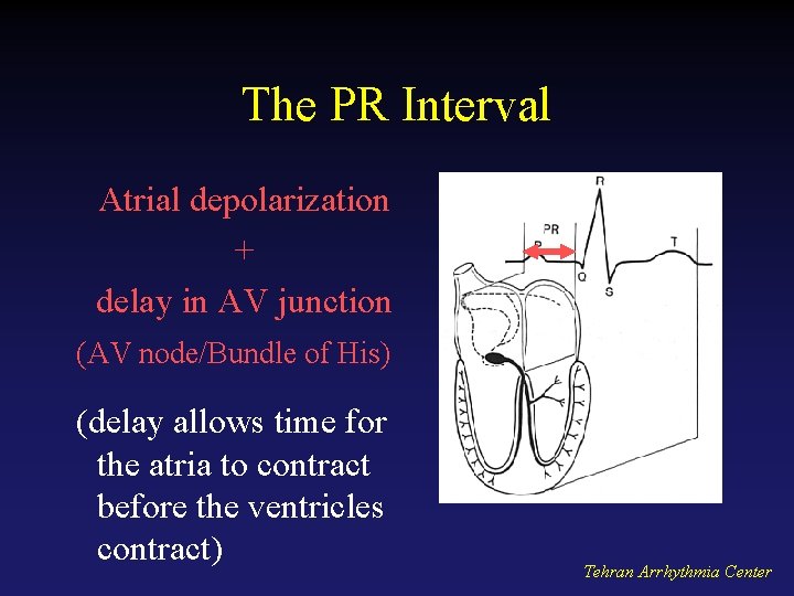 The PR Interval Atrial depolarization + delay in AV junction (AV node/Bundle of His)