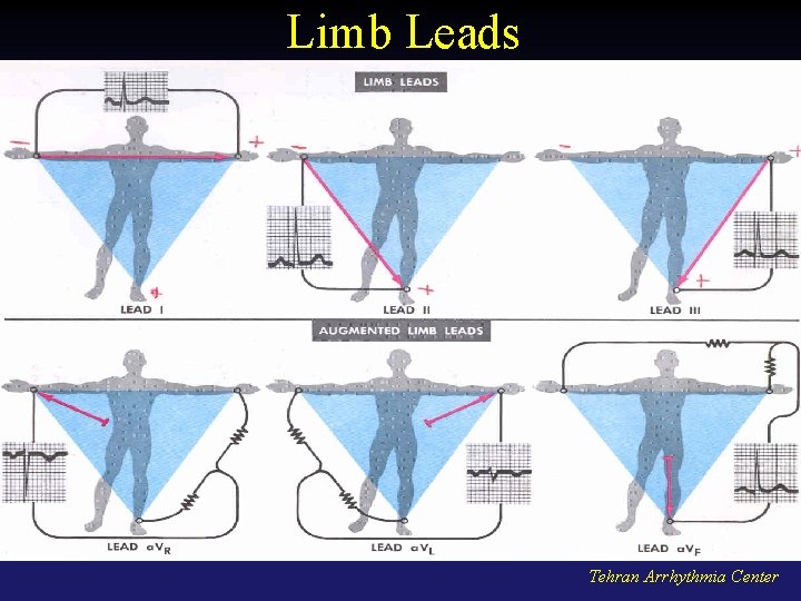 Limb Leads Tehran Arrhythmia Center 