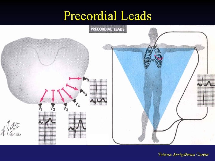 Precordial Leads Tehran Arrhythmia Center 