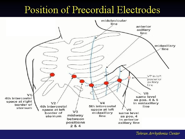 Position of Precordial Electrodes Tehran Arrhythmia Center 