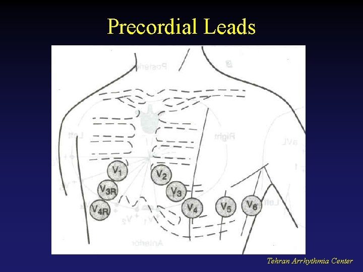 Precordial Leads Tehran Arrhythmia Center 