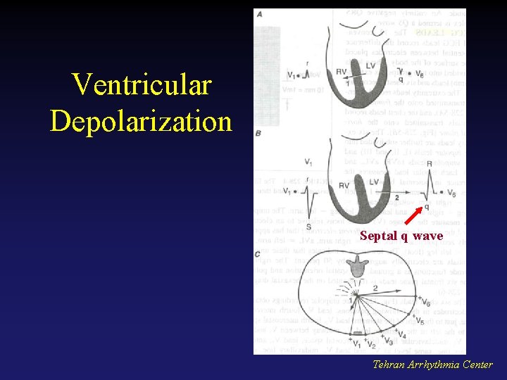 Ventricular Depolarization Septal q wave Tehran Arrhythmia Center 