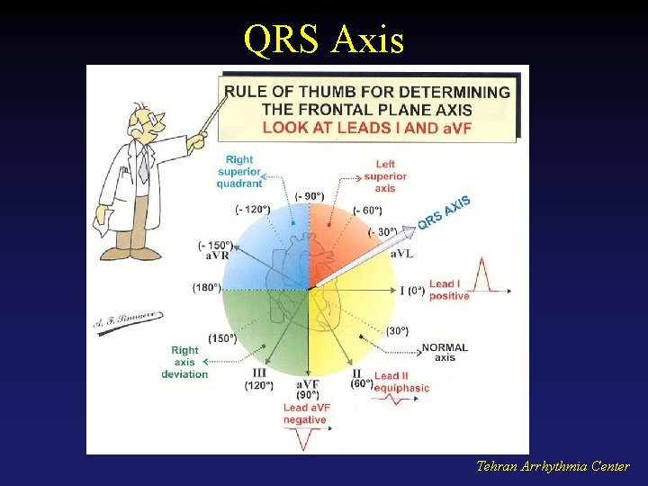 QRS Axis Tehran Arrhythmia Center 
