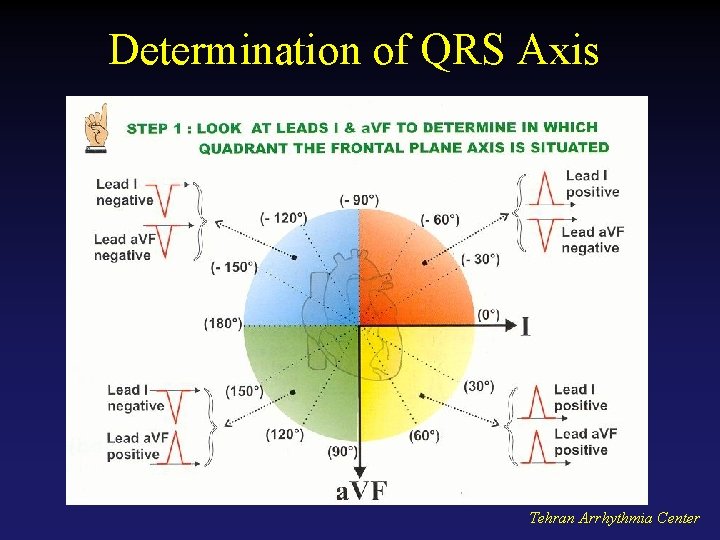 Determination of QRS Axis Tehran Arrhythmia Center 
