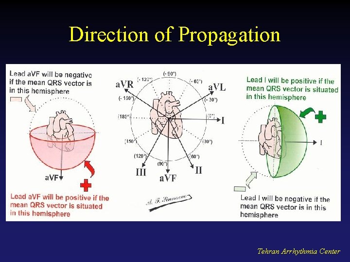 Direction of Propagation Tehran Arrhythmia Center 