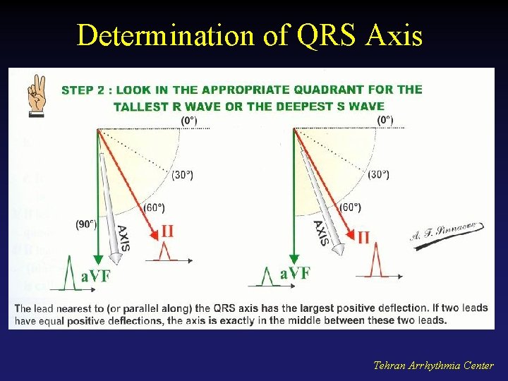 Determination of QRS Axis Tehran Arrhythmia Center 
