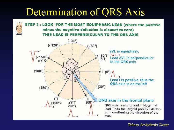 Determination of QRS Axis Tehran Arrhythmia Center 