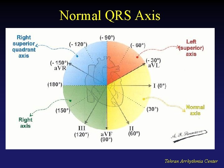 Normal QRS Axis Tehran Arrhythmia Center 