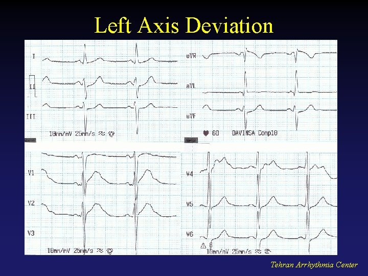 Left Axis Deviation Tehran Arrhythmia Center 