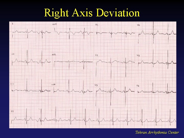 Right Axis Deviation Tehran Arrhythmia Center 