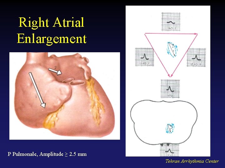 Right Atrial Enlargement P Pulmonale, Amplitude ≥ 2. 5 mm Tehran Arrhythmia Center 