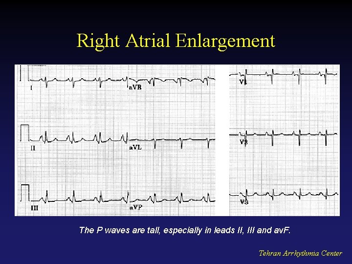 Right Atrial Enlargement The P waves are tall, especially in leads II, III and