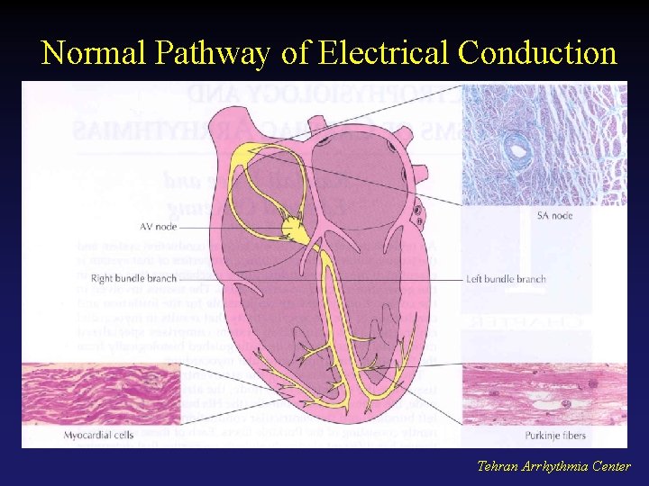 Normal Pathway of Electrical Conduction Tehran Arrhythmia Center 