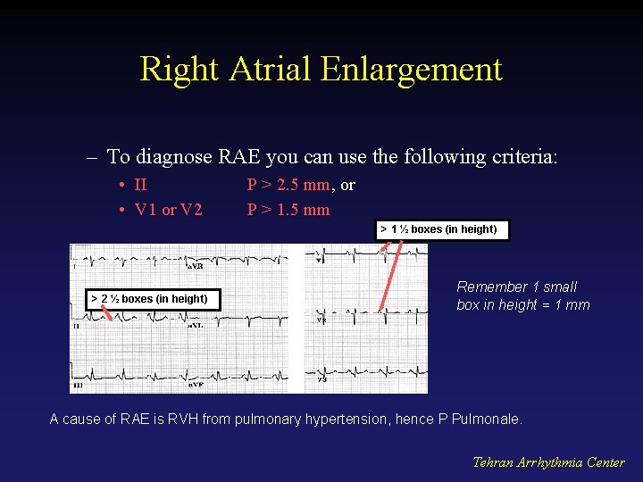 Right Atrial Enlargement – To diagnose RAE you can use the following criteria: •