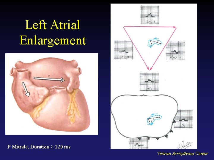 Left Atrial Enlargement P Mitrale, Duration ≥ 120 ms Tehran Arrhythmia Center 