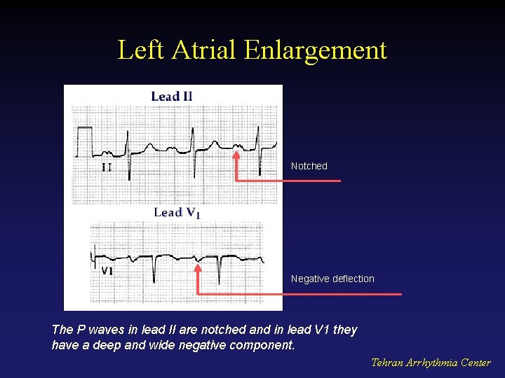 Left Atrial Enlargement Notched Negative deflection The P waves in lead II are notched