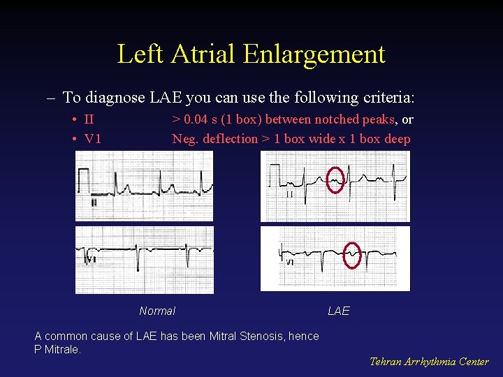 Left Atrial Enlargement – To diagnose LAE you can use the following criteria: •