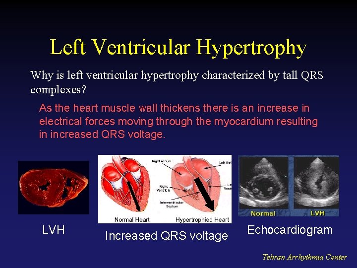 Left Ventricular Hypertrophy Why is left ventricular hypertrophy characterized by tall QRS complexes? As