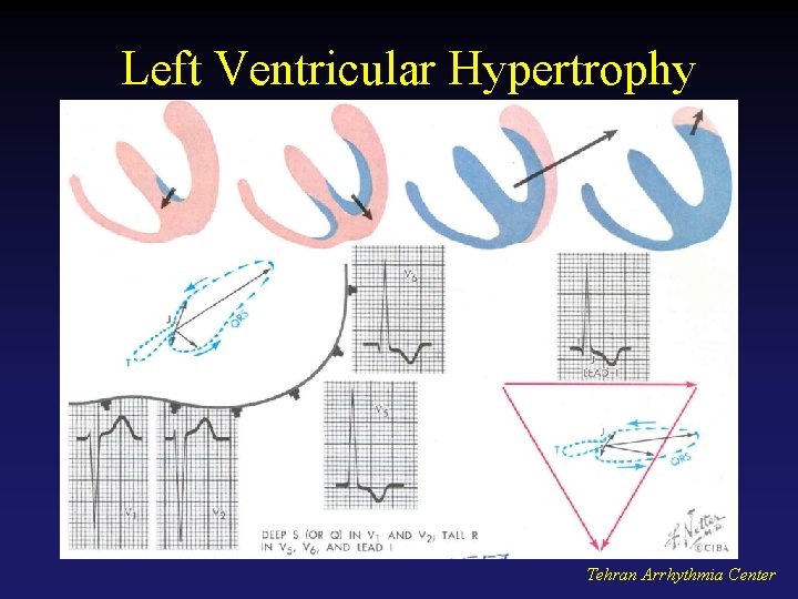 Left Ventricular Hypertrophy Tehran Arrhythmia Center 