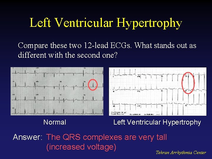 Left Ventricular Hypertrophy Compare these two 12 -lead ECGs. What stands out as different
