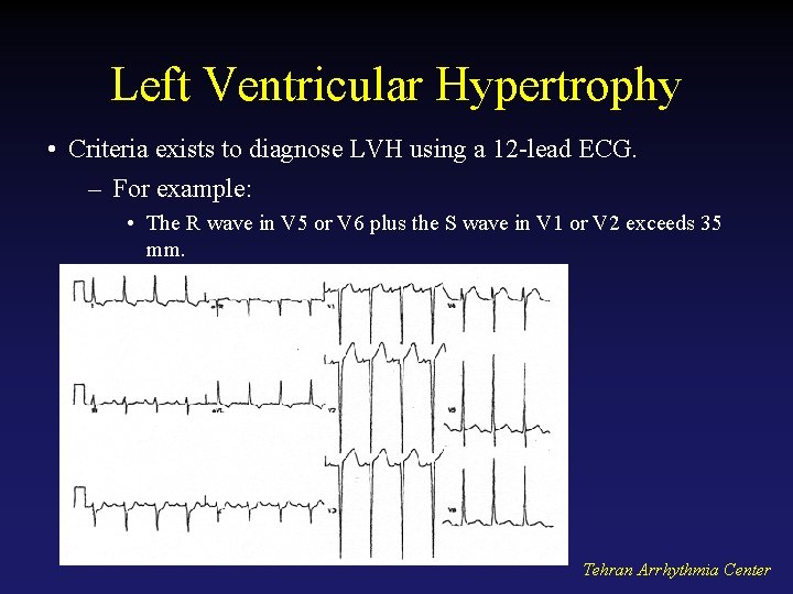 Left Ventricular Hypertrophy • Criteria exists to diagnose LVH using a 12 -lead ECG.