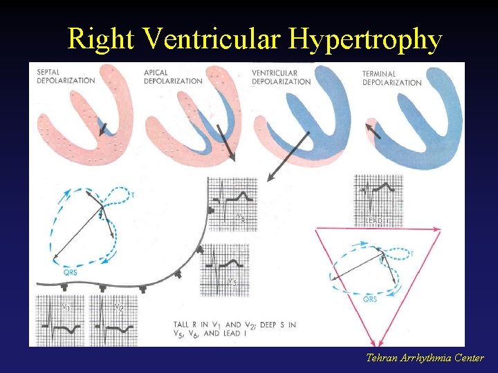 Right Ventricular Hypertrophy Tehran Arrhythmia Center 