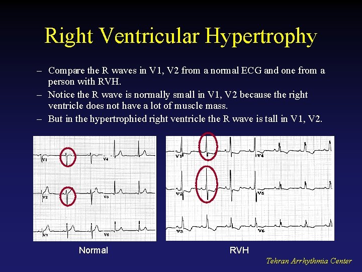 Right Ventricular Hypertrophy – Compare the R waves in V 1, V 2 from