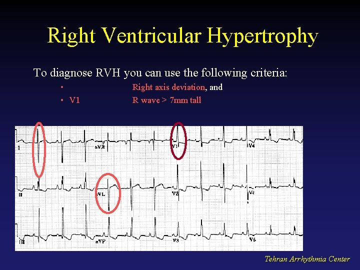 Right Ventricular Hypertrophy To diagnose RVH you can use the following criteria: • •