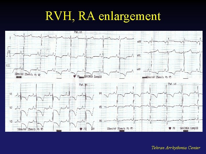 RVH, RA enlargement Tehran Arrhythmia Center 