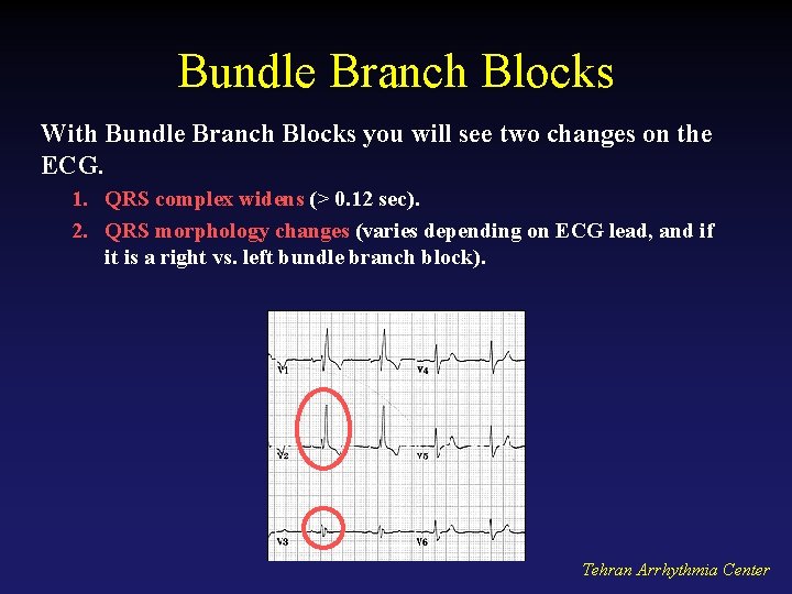 Bundle Branch Blocks With Bundle Branch Blocks you will see two changes on the