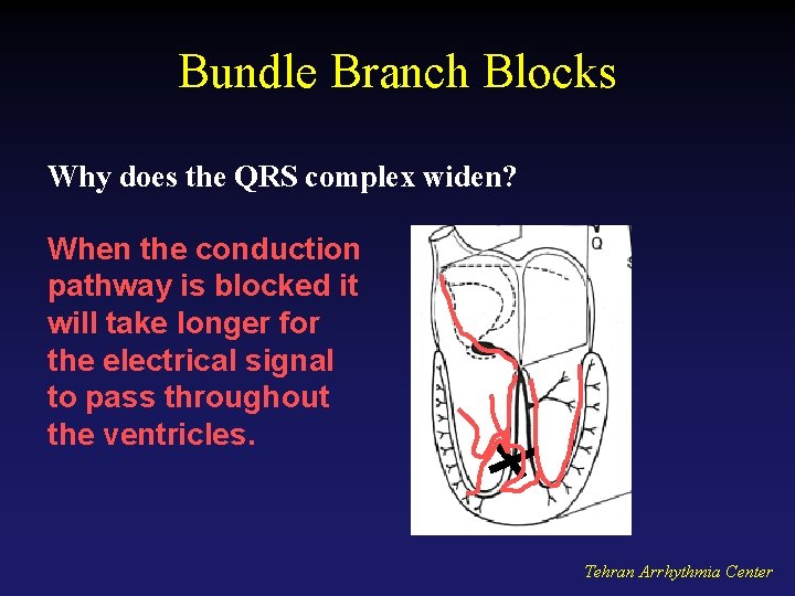 Bundle Branch Blocks Why does the QRS complex widen? When the conduction pathway is