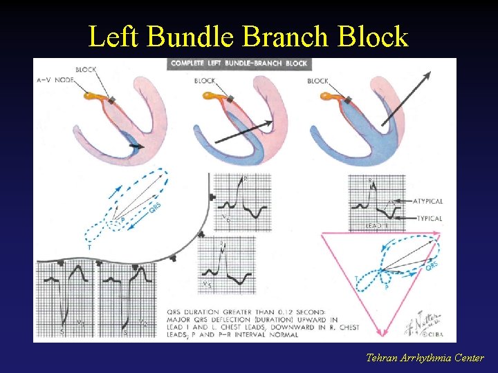 Left Bundle Branch Block Tehran Arrhythmia Center 